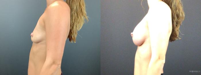 Before & After Breast Augmentation Case 269 Left Side View in St. Louis, MO