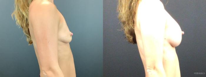 Before & After Breast Augmentation Case 269 Right Side View in St. Louis, MO