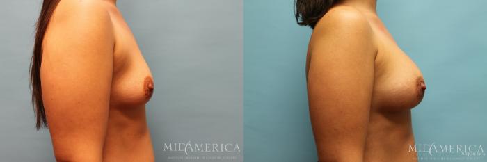 Before & After Breast Augmentation Case 27 View #5 View in Glen Carbon, IL