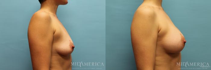 Before & After Breast Augmentation Case 28 View #5 View in St. Louis, MO