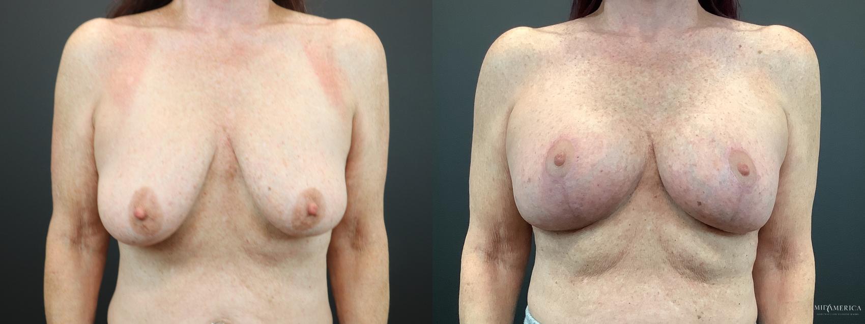 Before & After Breast Augmentation Case 283 Front View in St. Louis, MO