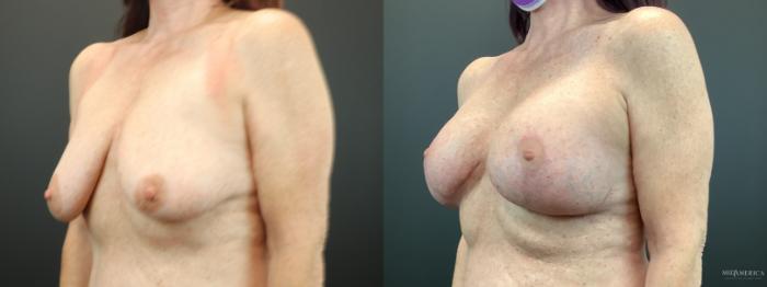 Before & After Breast Augmentation Case 283 Left Oblique View in St. Louis, MO