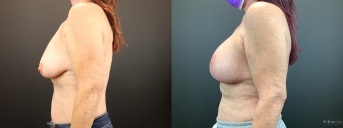 Before & After Breast Augmentation Case 283 Left Side View in St. Louis, MO