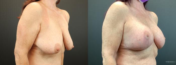 Before & After Breast Augmentation Case 283 Right Oblique View in St. Louis, MO