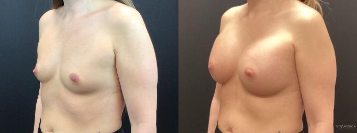 Before & After Breast Augmentation Case 286 Left Oblique View in St. Louis, MO