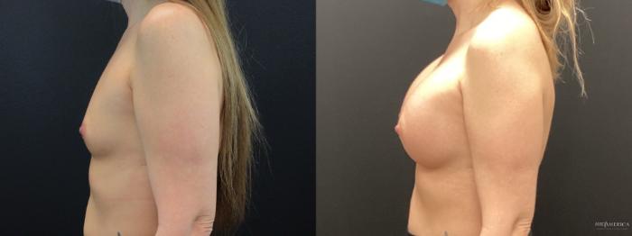 Before & After Breast Augmentation Case 286 Left Side View in St. Louis, MO