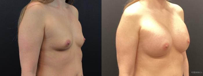 Before & After Breast Augmentation Case 286 Right Oblique View in St. Louis, MO
