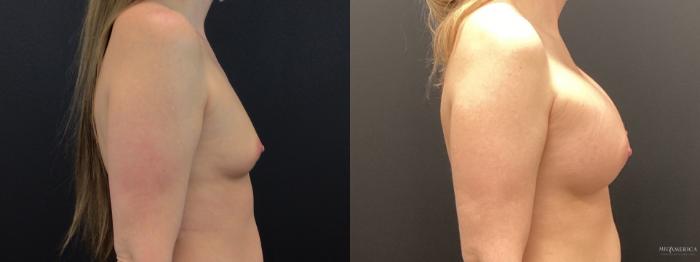 Before & After Breast Augmentation Case 286 Right Side View in St. Louis, MO