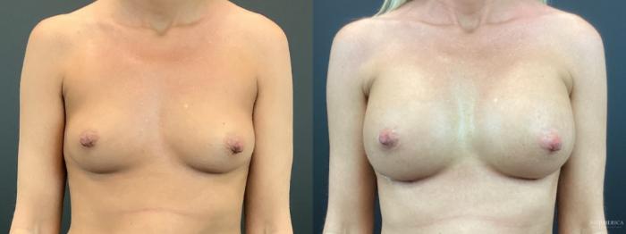 Before & After Breast Augmentation Case 292 Front View in St. Louis, MO