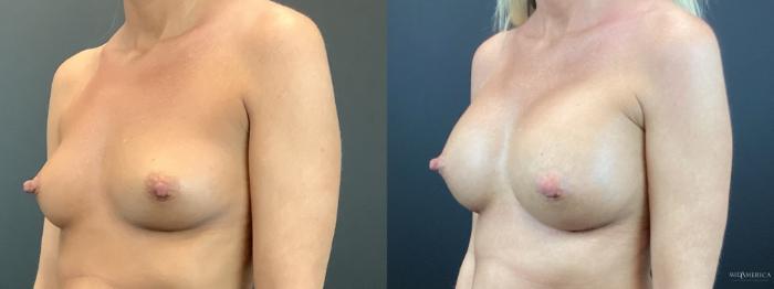Before & After Breast Augmentation Case 292 Left Oblique View in St. Louis, MO