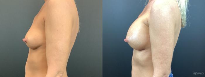 Before & After Breast Augmentation Case 292 Left Side View in St. Louis, MO