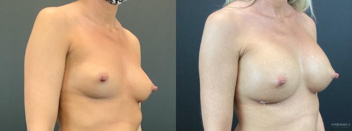 Before & After Breast Augmentation Case 292 Right Oblique View in St. Louis, MO