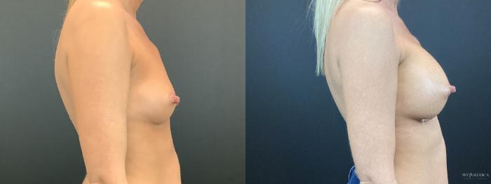 Before & After Breast Augmentation Case 292 Right Side View in St. Louis, MO