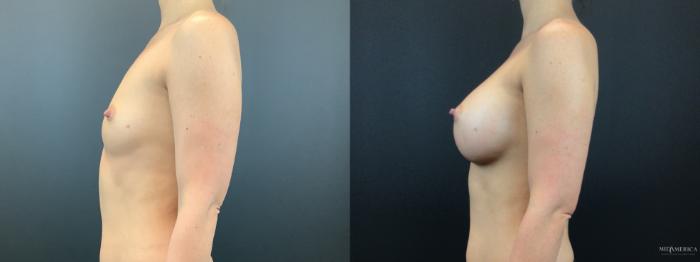 Before & After Breast Augmentation Case 303 Left Side View in St. Louis, MO