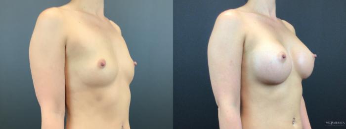 Before & After Breast Augmentation Case 303 Right Oblique View in St. Louis, MO