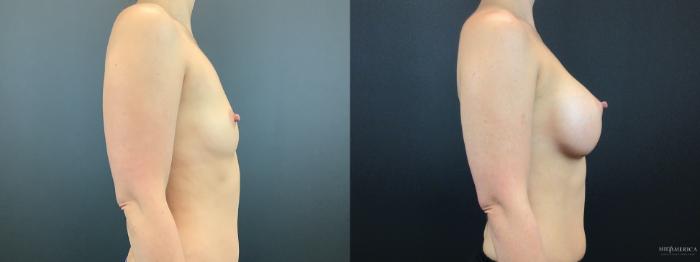 Before & After Breast Augmentation Case 303 Right Side View in St. Louis, MO