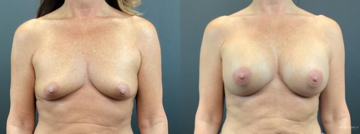 Before & After Breast Augmentation Case 312 Front View in St. Louis, MO