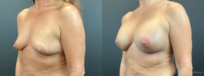Before & After Breast Augmentation Case 312 Left Oblique View in St. Louis, MO