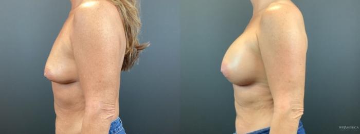 Before & After Breast Augmentation Case 312 Left Side View in St. Louis, MO