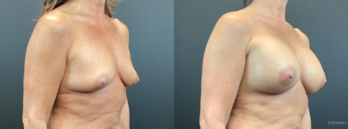Before & After Breast Augmentation Case 312 Right Oblique View in St. Louis, MO