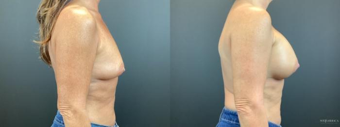Before & After Breast Augmentation Case 312 Right Side View in St. Louis, MO