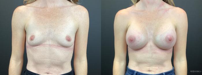 Before & After Breast Augmentation Case 316 Front View in St. Louis, MO