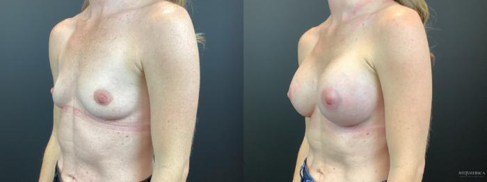 Before & After Breast Augmentation Case 316 Left Oblique View in St. Louis, MO
