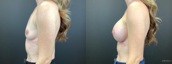 Before & After Breast Augmentation Case 316 Left Side View in St. Louis, MO
