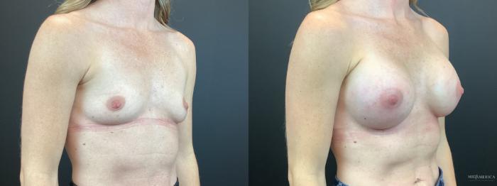 Before & After Breast Augmentation Case 316 Right Oblique View in St. Louis, MO