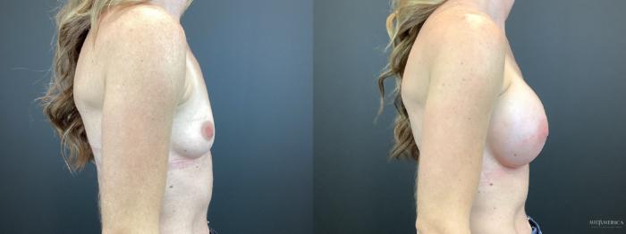 Before & After Breast Augmentation Case 316 Right Side View in St. Louis, MO
