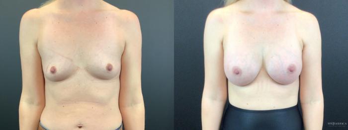 Before & After Breast Augmentation Case 318 Front View in St. Louis, MO