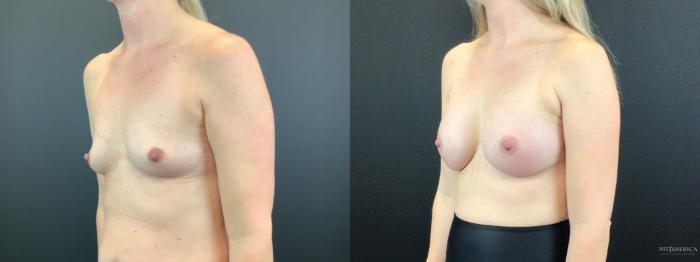 Before & After Breast Augmentation Case 318 Left Oblique View in St. Louis, MO