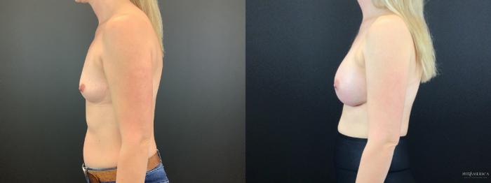 Before & After Breast Augmentation Case 318 Left Side View in St. Louis, MO