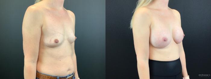 Before & After Breast Augmentation Case 318 Right Oblique View in St. Louis, MO