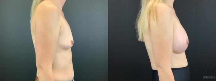 Before & After Breast Augmentation Case 318 Right Side View in St. Louis, MO