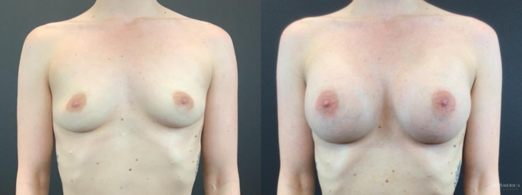 Before & After Breast Augmentation Case 319 Front View in St. Louis, MO