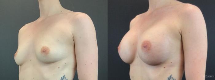 Before & After Breast Augmentation Case 319 Left Oblique View in St. Louis, MO