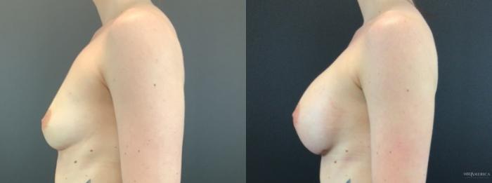 Before & After Breast Augmentation Case 319 Left Side View in St. Louis, MO