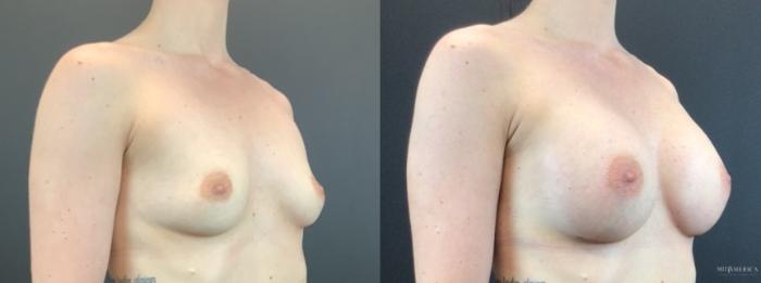 Before & After Breast Augmentation Case 319 Right Oblique View in St. Louis, MO