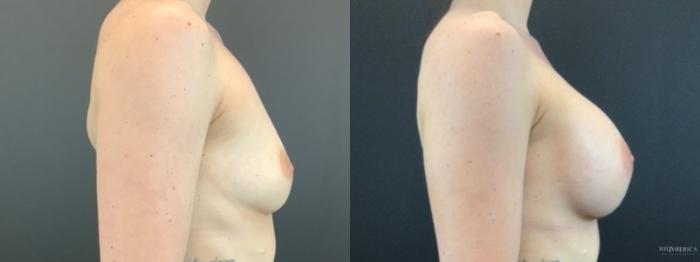 Before & After Breast Augmentation Case 319 Right Side View in St. Louis, MO