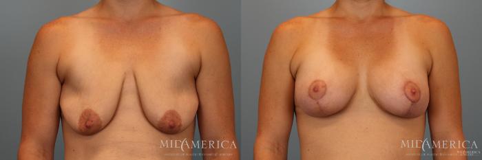 Before & After Breast Augmentation Case 32 View #1 View in Glen Carbon, IL