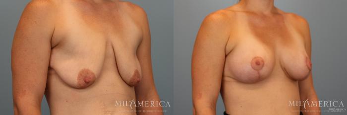 Before & After Breast Augmentation Case 32 View #2 View in Glen Carbon, IL
