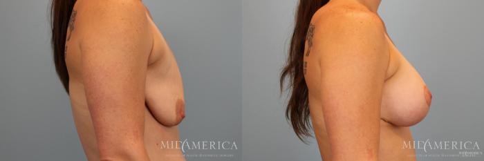 Before & After Breast Augmentation Case 32 View #3 View in Glen Carbon, IL
