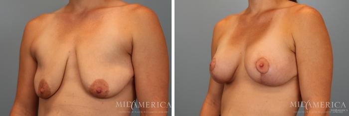 Before & After Breast Augmentation Case 32 View #4 View in Glen Carbon, IL