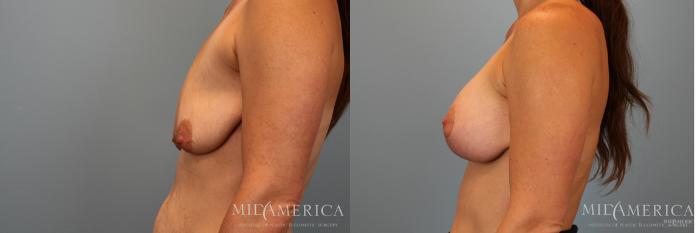 Before & After Breast Augmentation Case 32 View #5 View in Glen Carbon, IL