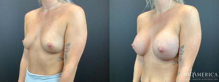 Before & After Breast Augmentation Case 332 Left Side View in St. Louis, MO