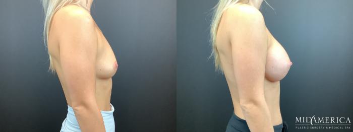 Before & After Breast Augmentation Case 332 Right Side View in St. Louis, MO