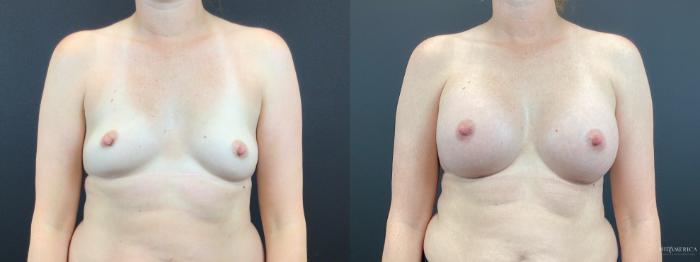 Before & After Breast Augmentation Case 333 Front View in St. Louis, MO