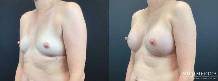 Before & After Breast Augmentation Case 333 Left Oblique View in St. Louis, MO