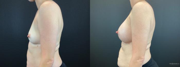 Before & After Breast Augmentation Case 333 Left Side View in St. Louis, MO